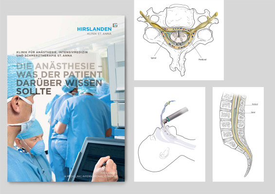 anestesia
